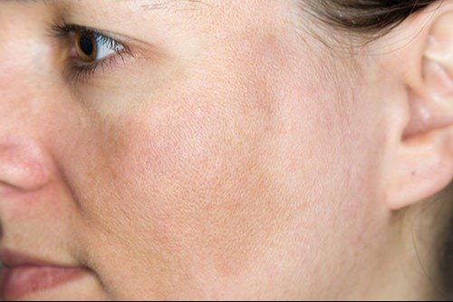 Reconoce los cuatro tipos de manchas que pueden aparecer en el rostro- Reconoce los cuatro tipos de manchas que pueden aparecer en el rostro