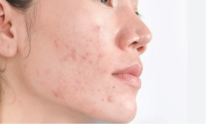 Reconoce los cuatro tipos de manchas que pueden aparecer en el rostro