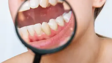 ¡Efectivo! Así es el remedio que acaba con el sarro de los dientes  ¡Efectivo! Así es el remedio que acaba con el sarro de los dientes