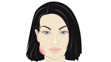 ¿Te has preguntado qué es un absceso y por qué salen?