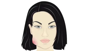 ¿Te has preguntado qué es un absceso y por qué salen? ¿Te has preguntado qué es un absceso y por qué salen?