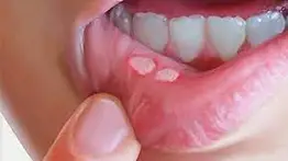  ¿Por qué salen llagas en la boca?        