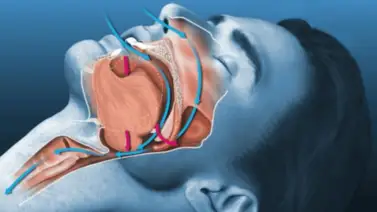 Aprueban en EEUU medicamento para controlar la apnea obstructiva del sueño Aprueban en EEUU medicamento para controlar la apnea obstructiva del sueño