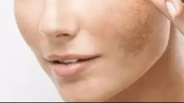 Aclara las manchas del rostro con esta mascarilla natural Aclara las manchas del rostro con esta mascarilla natural