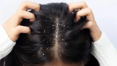 ¿Por qué se produce la caspa y como eliminarla? ¿Por qué se produce la caspa y como eliminarla?