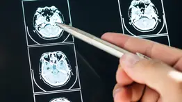 Aprenden a jugar con la mente: implante cerebral cambia la vida de las personas con parálisis